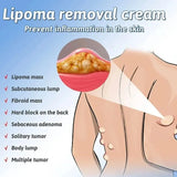 Lipoma Removal  Cream | Herbal Skin Care Cream for Smooth & Nourished Skin | Fast-Absorbing Formula | For Neck & Body | 50g